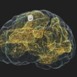 Implante cerebral