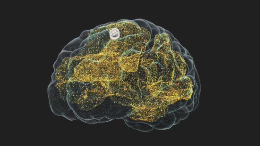 Implante cerebral